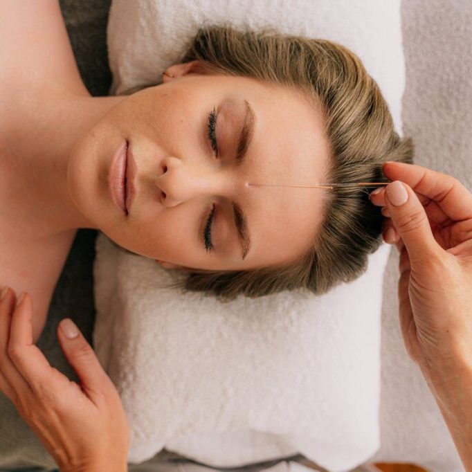 woman receiving an acupuncture treatment